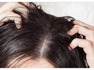 비듬을 없애려면