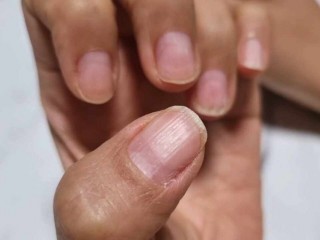 손톱이 발톱보다 빨리 자라는 까닭
